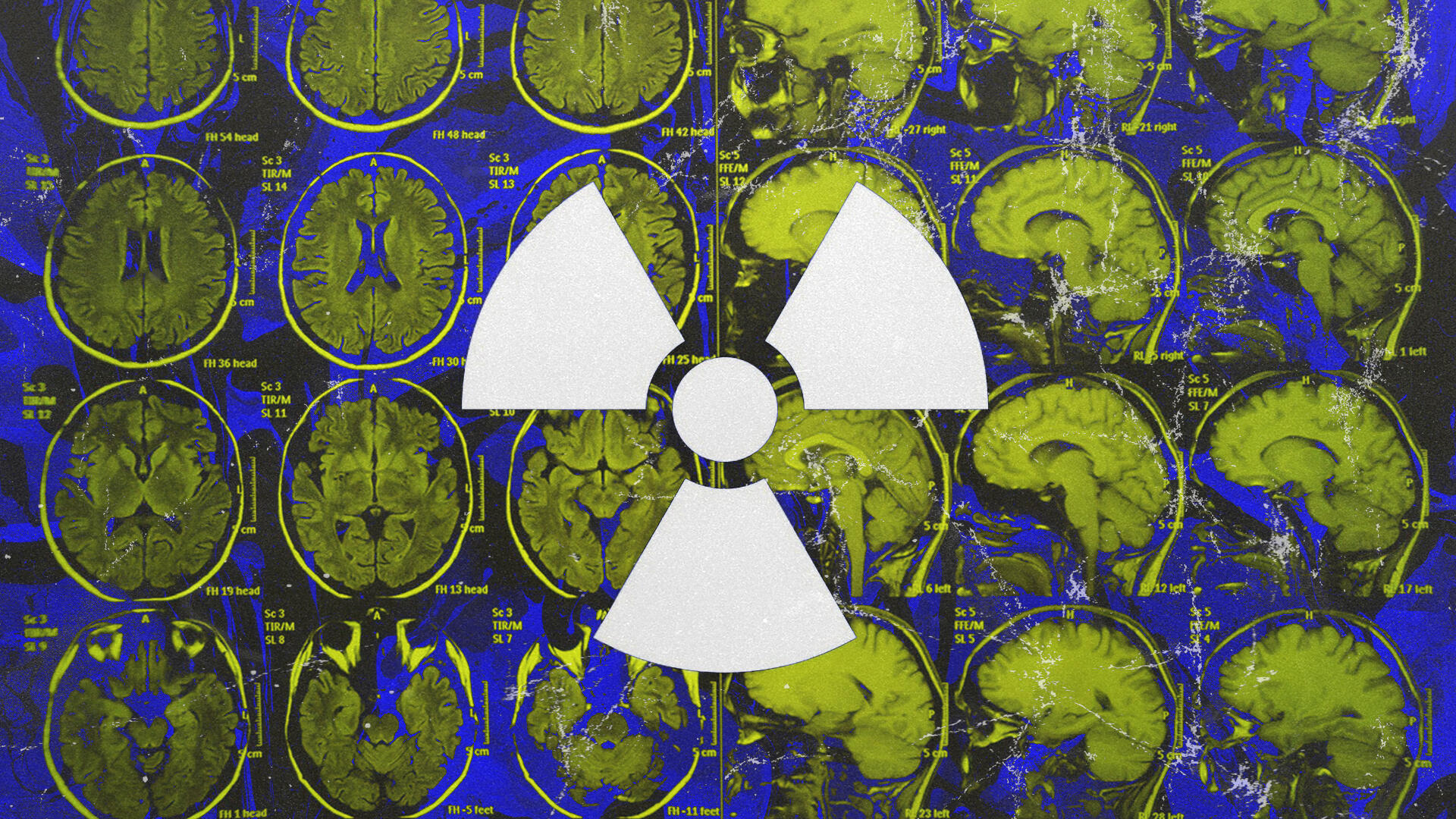 Unprotected Xrays Cause Cancer An Investigation Into Hospitals in